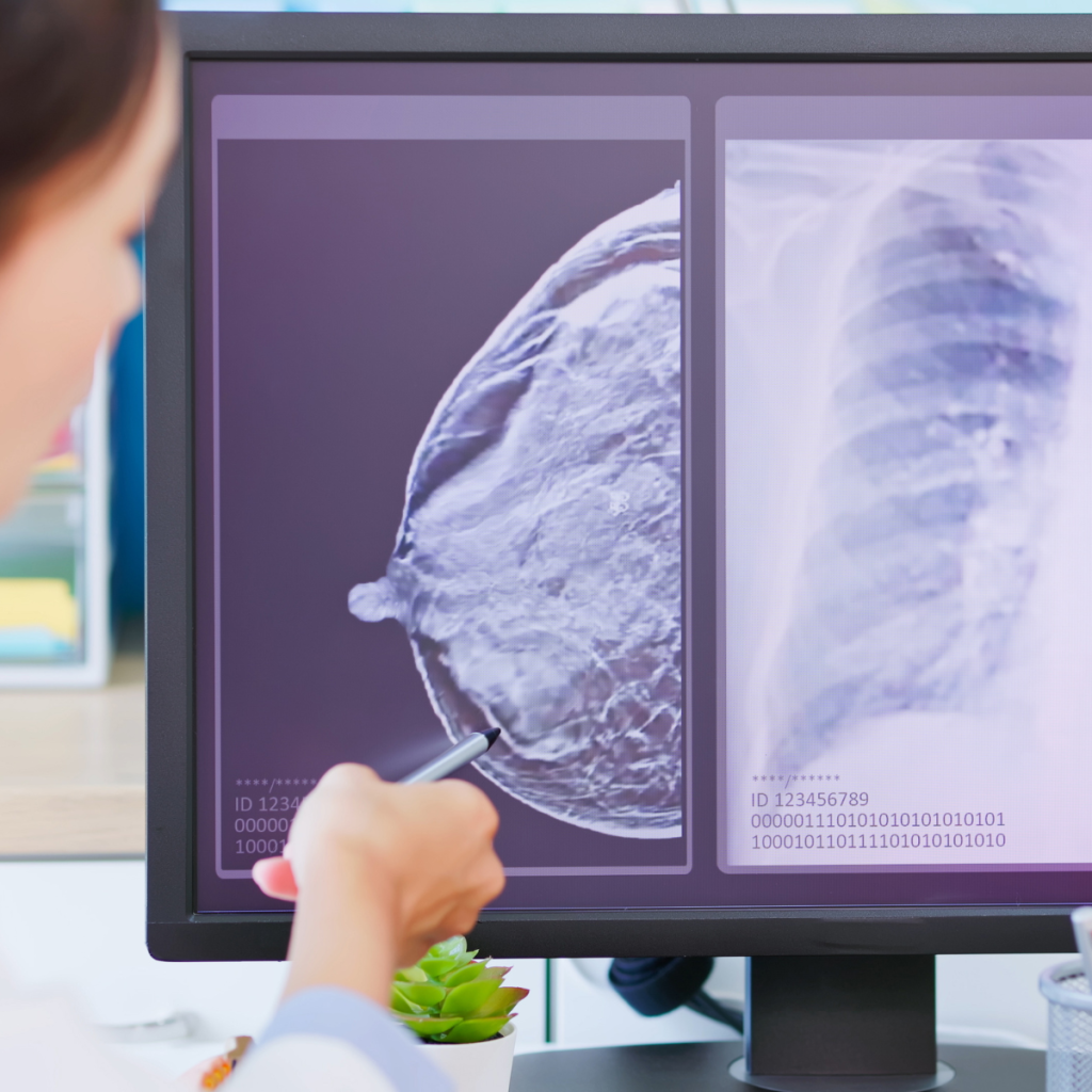 IH - Breast Cancer Screening Healthcare professional reviewing a mammogram image on a computer screen.